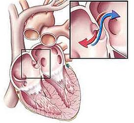 Obat Jantung Bocor